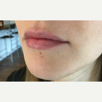 Juvederm Ultra treatment for this 32 year old woman before 3163418