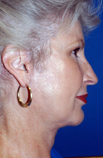 67 Year Old Female Treated for Aging Face after 1028253