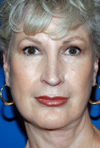 67 Year Old Female Treated for Aging Face 1028253