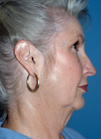 67 Year Old Female Treated for Aging Face before 1028253