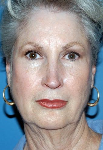 67 Year Old Female Treated for Aging Face 1028253