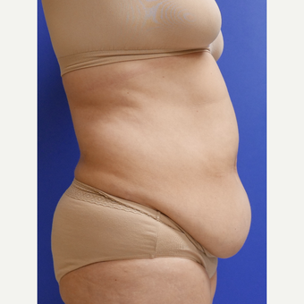 55-64 year old woman treated with Tummy Tuck before 3165597