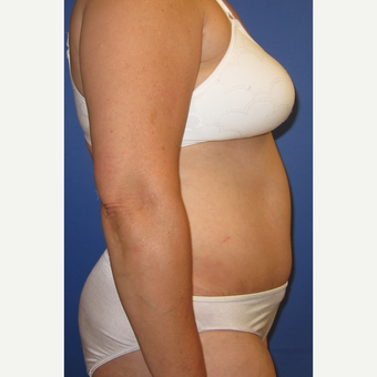 55-64 year old woman treated with Tummy Tuck after 3165597