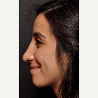 Middle Eastern Rhinoplasty - Dramatic Transformation for Facial Harmony after 2993895