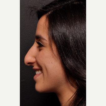 Middle Eastern Rhinoplasty - Dramatic Transformation for Facial Harmony before 2993895