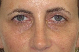 Tear trough deformity (orbital rim hollowying) and loss of midface volume. The dark shadows are a result of a loss of volume in before 1032181
