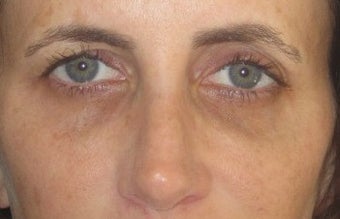 Tear trough deformity (orbital rim hollowying) and loss of midface volume. The dark shadows are a result of a loss of volume in after 1032181