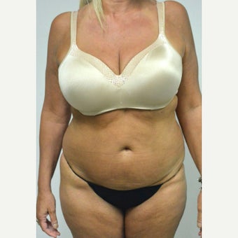 45-54 year old woman treated with Mini Tummy Tuck before 2211322