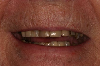 Full mouth rehabilitation. before 349671
