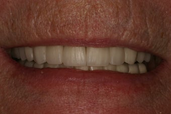 Full mouth rehabilitation. after 349671