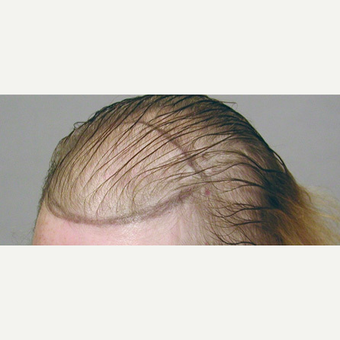 Hair Transplant before 3241484