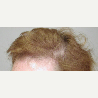 Hair Transplant after 3241484