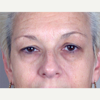 45-54 year old woman treated with Eyelid Surgery before 3213223