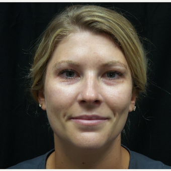 25-34 year old woman treated with Belotero before 3564747