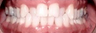 25-34 year old woman treated with Invisalign