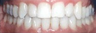 25-34 year old woman treated with Invisalign