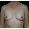 45-54 year old woman treated with Breast Augmentation with Sientra Shaped 370cc Gummy Bear Implants