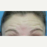 Treated with Botox