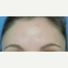 Treated with Botox