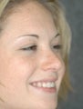 Rhinoplasty