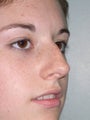 Rhinoplasty