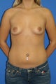 Breast Augmentation
