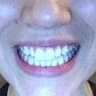 18-24 year old woman treated with Invisalign