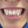 18-24 year old woman treated with Invisalign