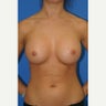 25-34 year old woman treated with Breast Augmentation