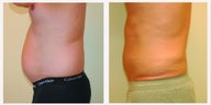 Smart Lipo