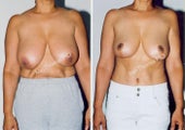 Tummy Tuck and Breast Reduction