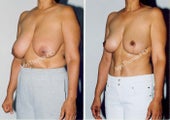 Tummy Tuck and Breast Reduction