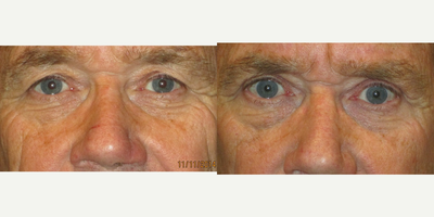 55-64 year old man treated with Eyelid Surgery - Patient chose to have an upper blepharoplasty under local anesthesia in the office. His downtime was approximately 3 days. His results demonstrate more definition of his upper eyelids with removal of significant upper eyelid skin. Most female patients will state that it is easier to apply makeup around the eyes after the procedure has healed. A majority of patients od not use.