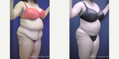 Tummy Tuck - Tummy Tuck