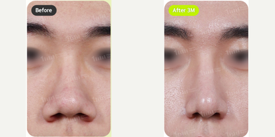 25-34 year old man treated with Alarplasty, Rhinoplasty - 25-34 year old man treated with Alarplasty, Rhinoplasty