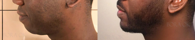 35-44 year old man treated with Chin Implant -