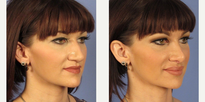 25-34 year old woman treated with Rhinoplasty - Here is a woman at her 2 months appointment after rhinoplasty surgery. The tip is still slightly swollen and this will improve over the next few months.