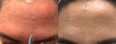 25-34 year old woman treated with Plasma Pen - Patient treated with plasma pen. Picture taken 2 weeks apart.