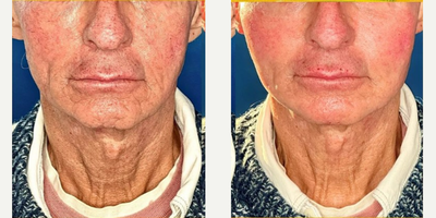 Man treated with Xeomin - Man treated with Xeomin.
