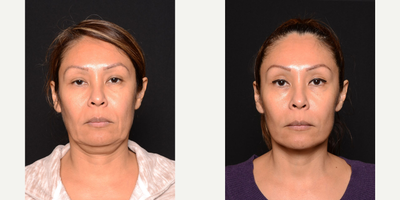 Woman treated with Mini Lift - Woman treated with Mini Lift