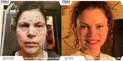 45-54 year old woman treated with Deep Plane Facelift, Facelift, Neck Lift, Lip Lift, Facial Fat Transfer, Eyelid Surgery - 45-54 year old woman treated with Deep Plane Facelift, Facelift, Neck Lift, Lip Lift, Facial Fat Transfer, Eyelid Surgery