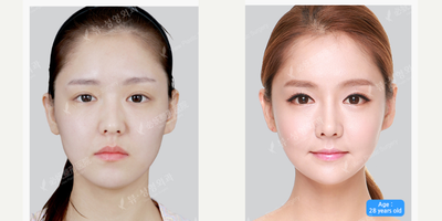 25-34 year old woman treated with AccuLift - Accu-lift+Omega Lift+V-line Surgery+Cheekbone Reduction+T.O.P Rhinoplasty