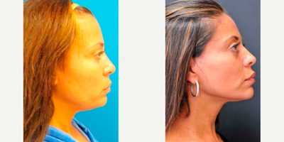42 year old woman treated with Facelift - 42 year old woman treated with Facelift