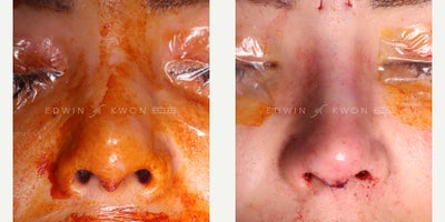 25-34 year old woman treated with Asian Rhinoplasty, DCF Rhinoplasty - 25-34 year-old woman treated with DCF Rhinoplasty. Patient felt her nose appears low and flat. She was not satisfied with the appearance of her nose tip as well. She had prior filler injection to her nose and was happy with the height of her bridge but was still not satisfied with her nasal tip. She had wanted a more permanent change. She had her filler dissolved prior to the surgery by her original provider but there still remained a significant amount of filler during the surgery. Additional hyaluronidase was injected and filler was directly removed. Her nasal bridge height was re-established utilizing a DCF graft. Her nasal tip projection was increased utilizing septal extension graft and conchal cartilage tip grafts.