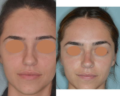 18-24 year old woman treated with Rhinoplasty - Female patient who was unhappy with the appearance of her nose. Her main concerns included the wide, bulbous tip and the slight nasal hump on her profile. A primary rhinoplasty was performed which included the reduction of the hump, placement of spreader grafts, a caudal septal extension graft, and tip graft. Seen here are her 3 month post-op photos. Patient wanted a natural-appearing tip with refinements. Post-op photos taken from her frontal, profile, and base view show the refinements made with a primary rhinoplasty procedure.