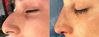 Patient treated with Rhinoplasty - The nose is major focal point on the face and always needs to be proportial and fit the patients face properly. There is no cookie cutter nose, each nose is created to accentuate the features of the face and remain as natural looking as possible