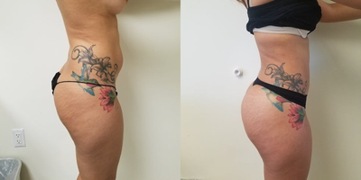 25-34 year old woman treated with Brazilian Butt Lift - Overall very fit woman, with moderate volume lipo and fat enhancement of buttocks, at three months postop.