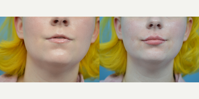 18-24 year old woman treated with Juvederm - 22 year old treated with Juvederm to add more volume.