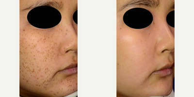Woman treated with PicoSure - Woman treated with PicoSure