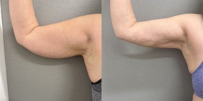 45-54 year old woman treated with Liposuction - 54 y/o underwent arm liposuction in our office O.R. under sedation.